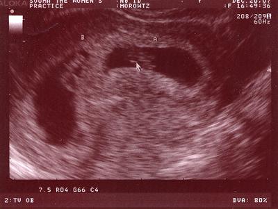 Baby Gear  Multiples on Week Ultrasound   Twins