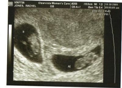 8 Weeks Fraternal Twins Ultrasound