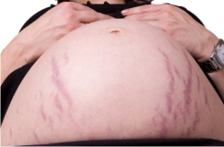 twin pregnancy stretch marks