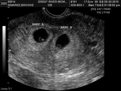 Pregnant With Twins Ultrasound 58
