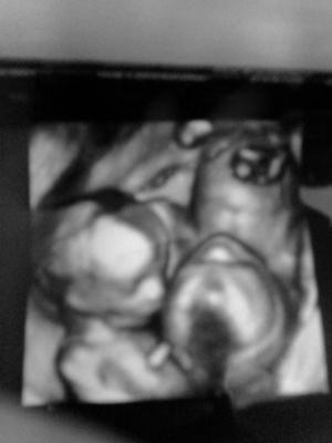 3d ultrasound pictures at 20 weeks. 3d Ultrasound Of Twins