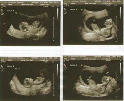Scan Picturesweeks on Identical Twins Pregnancy Scan At 15 Weeks 5 Days