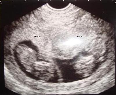 Janna's Twin Ultrasound Images