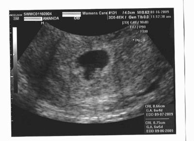 first ultrasound (7 weeks)