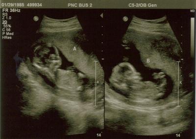 My Twins At 14 Weeks - Ultrasound