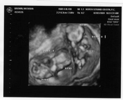 Scan Picturesweeks on One Plus One Equals Two   10 Week Ultrasound