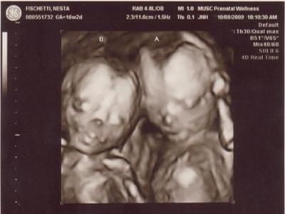 Amazing 3D Twins Ultrasound Image - 16 Weeks