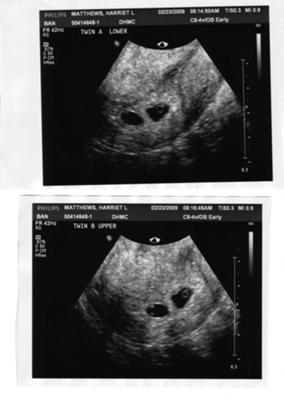IVF Twins 5 Weeks 6 Days - Teeny & Tiny!