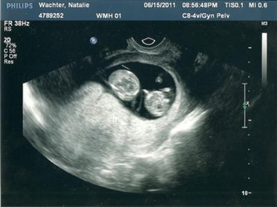 Images ultrasound twin pregnancy Customize Fake