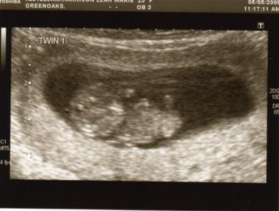10 weeks...twin 1