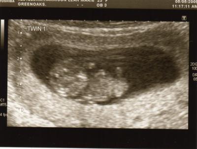 10 weeks...twin 1