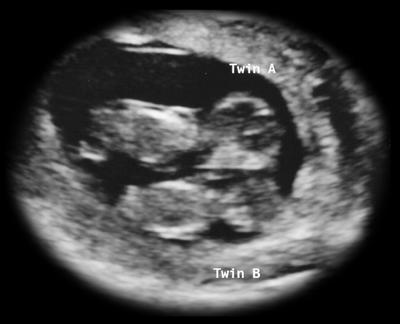 At 13 weeks ultrasound Pregnancy Ultrasounds