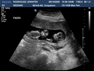 14 Weeks / Faces of Baby A and Baby B