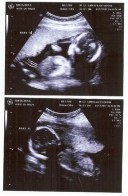 My very first ultrasounds Baby A on top, Baby B on bottom.