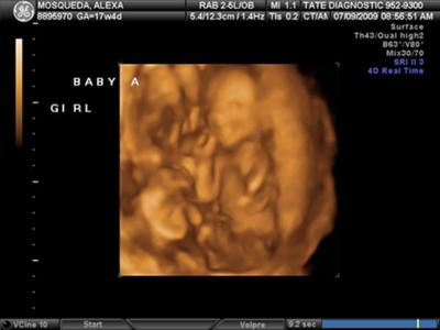 Baby A (Ava) 3D 17w 4d