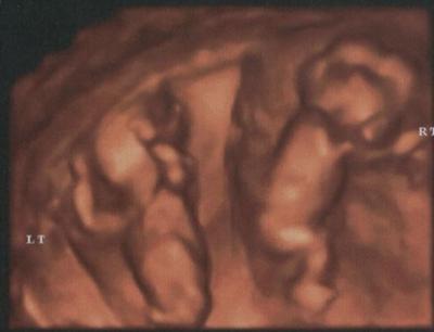12 weeks 5 days 4D ultrasound