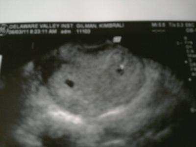 4 weeks 3 days ultrasound Your 6