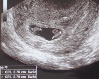 7 week ultrasound twins