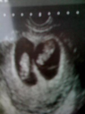 8 weeks didi boygirl twins ultrasound 21441526