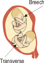 Breech/Transverse Twins