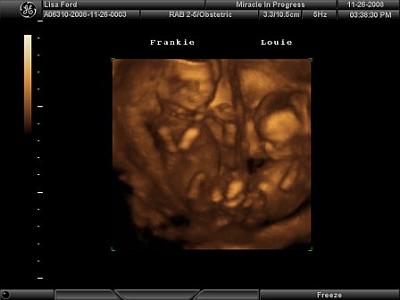 Boy / Girl Twins - 3D Ultrasound 15 weeks 5 days