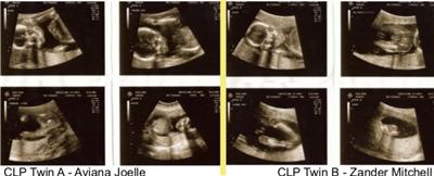 Aviana Joelle & Zander Mitchell  - 19 week ultrasound