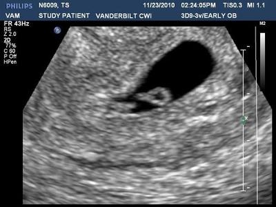 1 baby or 2?