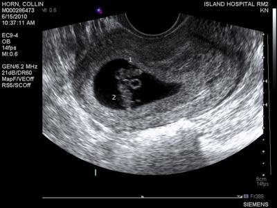 saw two heartbeats