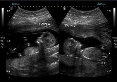 Fraternal Twins - 13 Weeks Ultrasound