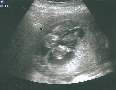 actual 13 week fetus actual 13 week fetus