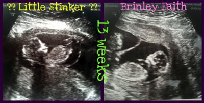 Fraternal Twins at 13 Weeks 3 Days