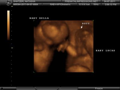 Fraternal Twins at 15 Weeks Ultrasound