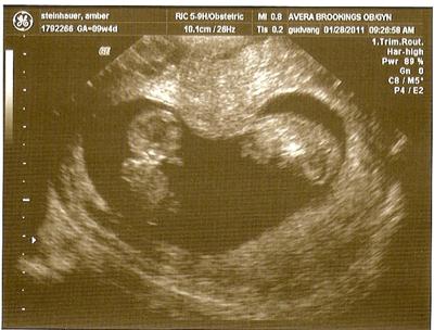 Heart-shaped @ 9 weeks 4 days