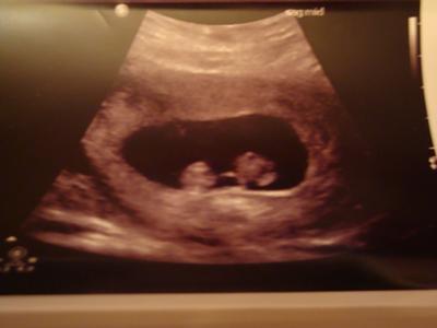 But this ultrasound pic was from when I was about 9 weeks 3 days. 
