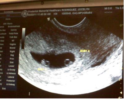 ultrasound at 6 weeks twins