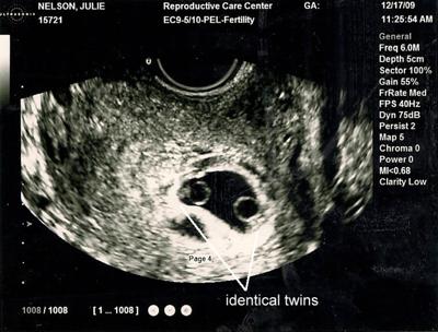 Identical Twins Ultrasound - 7 Weeks 2 Days