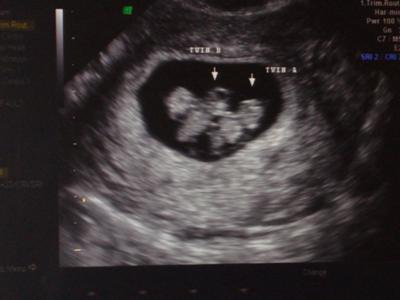 Mono-Amniotic Twins At 8 Weeks
