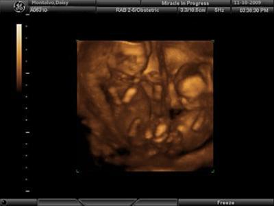 My Babies - 3D Twins Ultrasound