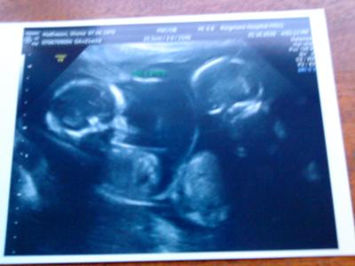 twin due date calculator twin due date calculator