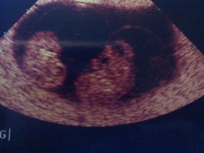 My Twin babies.... 9 wks 0 days :)