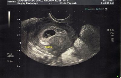My Twins Ultrasound at 6 Weeks - Identical or Not?