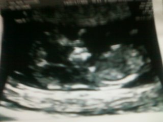 baby A at11wks 