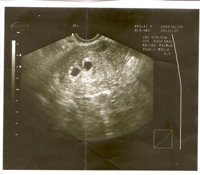 Weeks 4 ultrasound at Ultrasound at