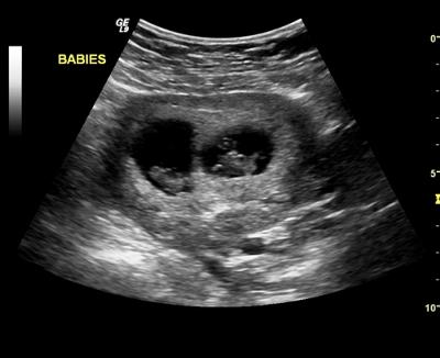 Twins ultrasound for Twin pregnancy