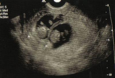4 4 days weeks ultrasound hcg levels