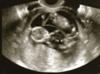 Slinky Babies - 12 1/2 week scan