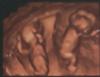 12 weeks 5 days 4D ultrasound