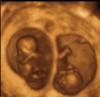 mc twins 11 weeks