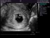 6 Week Ultrasound