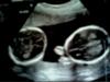 mono-di girls at 20 wks